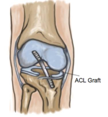 ACL Reconstructions -img