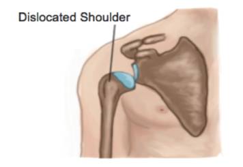 Shoulder Dislocations